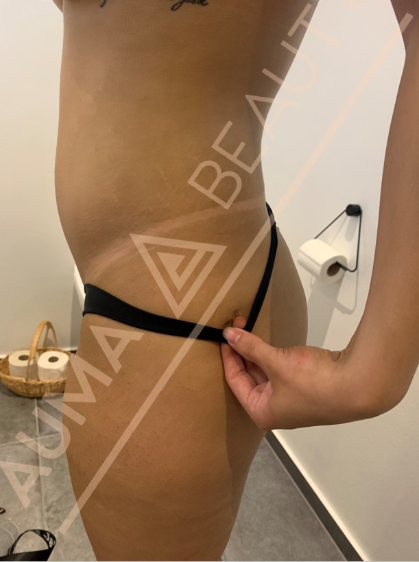 Spraytan